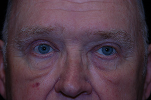 Blepharoplasty 7b